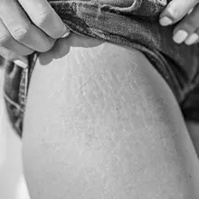 Stretchmarks